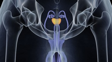 Comprensión de las pruebas genéticas del cáncer de próstata mal interpretadas por algunos hombres