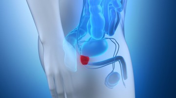 Incidence of metastatic prostate cancer rates almost double