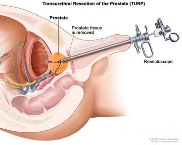 Staging the disease of prostate cancer