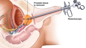 Staging the disease of prostate cancer